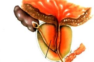 Qu'est-ce que la prostatite chez les hommes