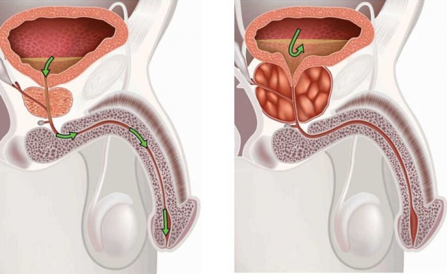Prostate saine et enflammée.
