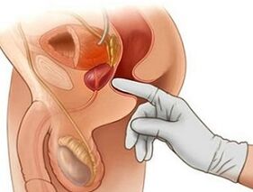 Massage de la prostate pour le traitement de la prostatite chez l'homme.