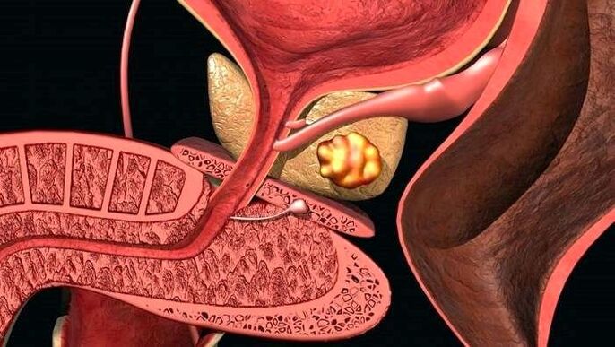 Dépôts de calculs dans la prostate avec prostatite calculeuse.