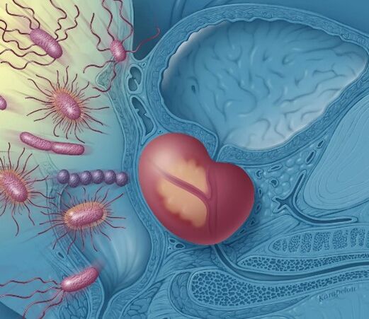 inflammation de la prostate
