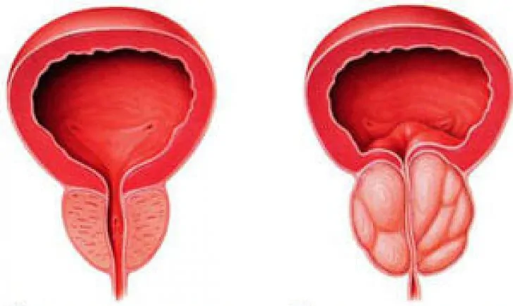Prostate normale (à gauche) et prostatite inflammatoire chronique (à droite)