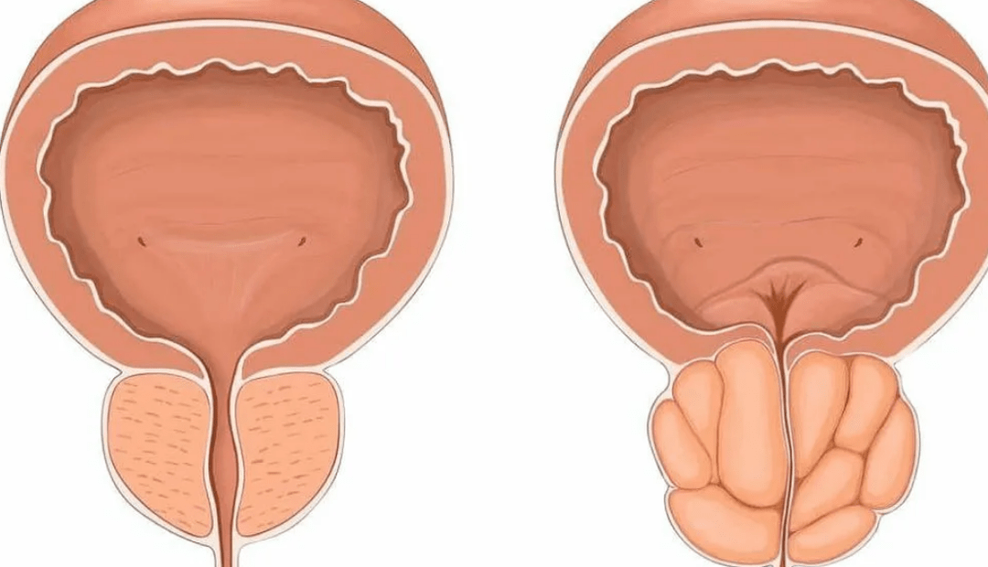 prostate saine et malade