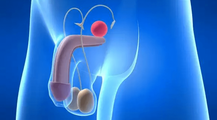 La prostatite est une inflammation de la prostate chez l'homme qui nécessite un traitement complexe. 
